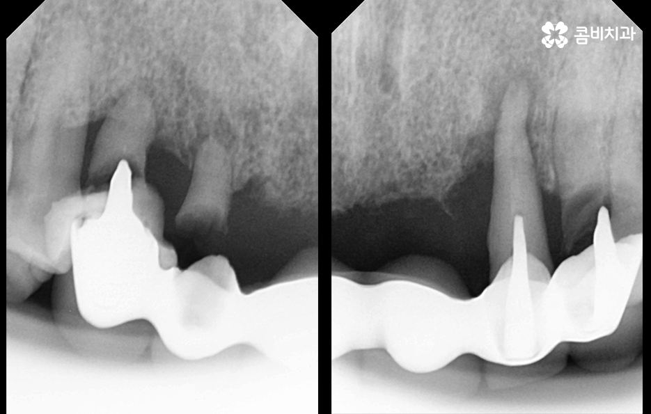 앞니임플란트 이런 조건들을 따져보세요 관련 이미지 2