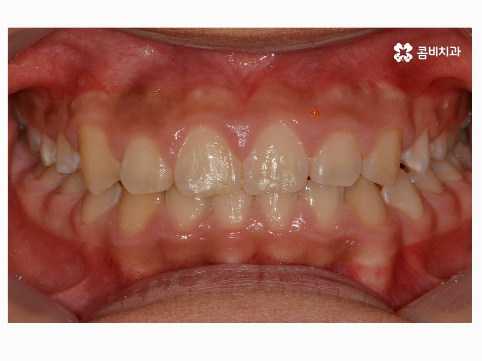 과개교합교정 어릴때 고쳐주면 좋은 사례 관련 이미지 13