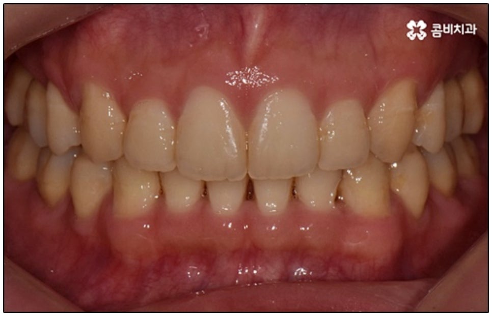 클리피씨교정 알아봐야 할것들 관련 이미지 9