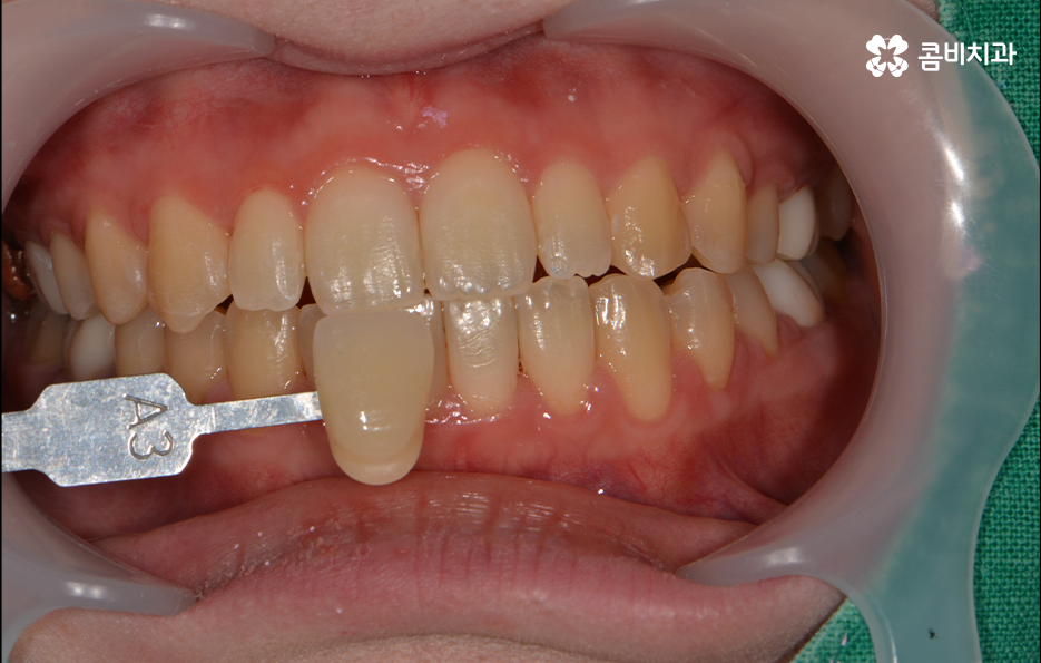 치과치아미백 어떻게 다른지 설명해드려요 관련 이미지 1