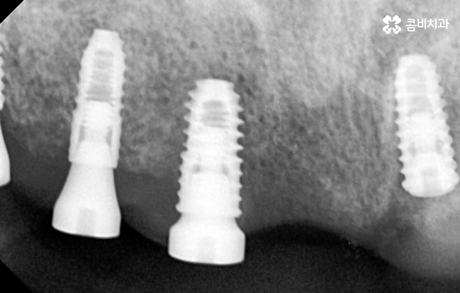 임플란트 나이 얼마나 영향을 줄까 관련 이미지 7