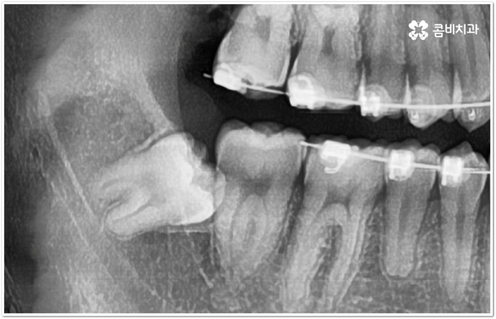 아래사랑니발치 망설이고 있다면 관련 이미지 5