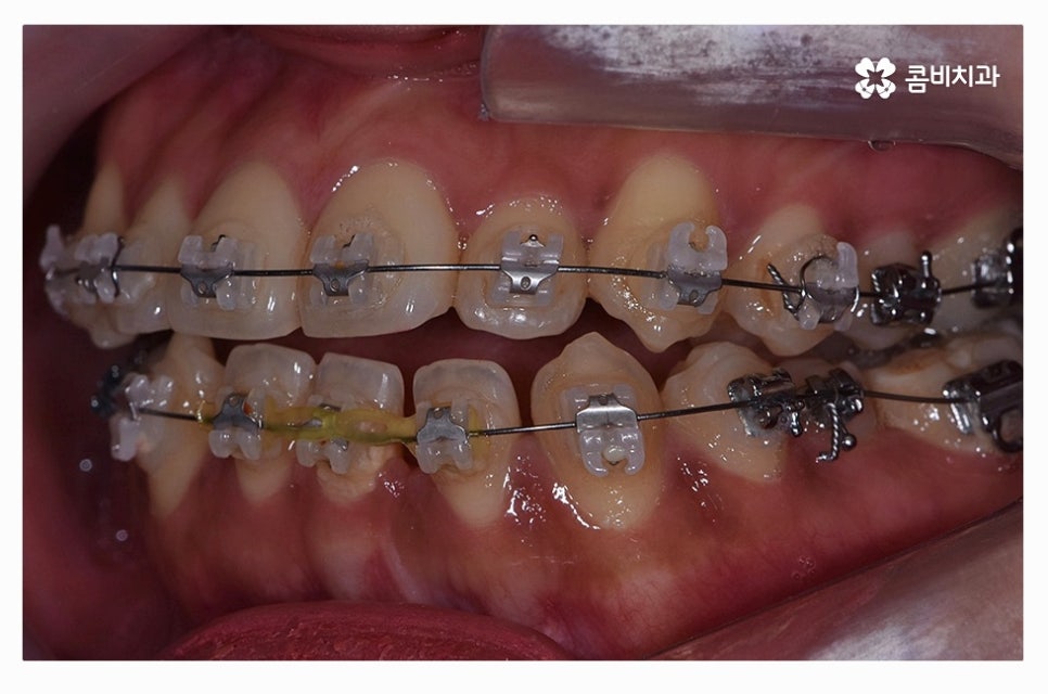 덧니교정 정교하게 따져보려면 관련 이미지 9