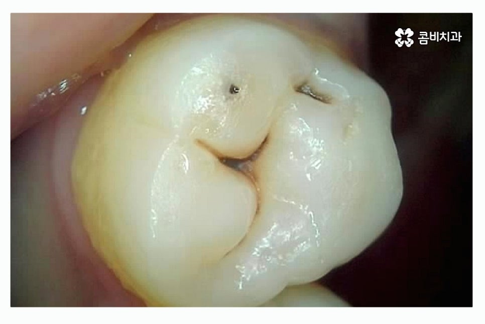 충치 레진 인레이 합리적으로 결정하려면 관련 이미지 2