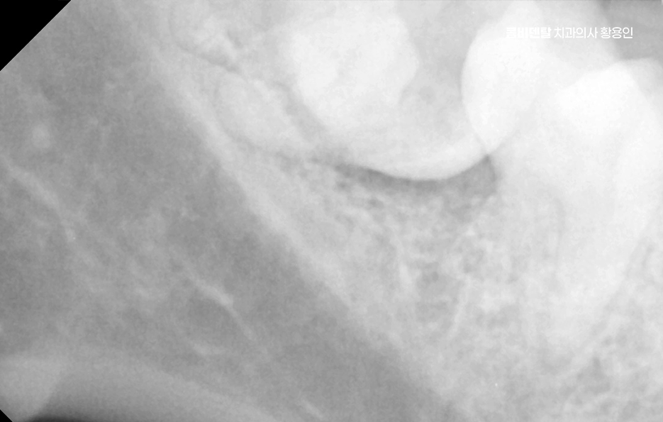 사랑니 발치 후 충치 치료 둘다 준비하려면 관련 이미지 8
