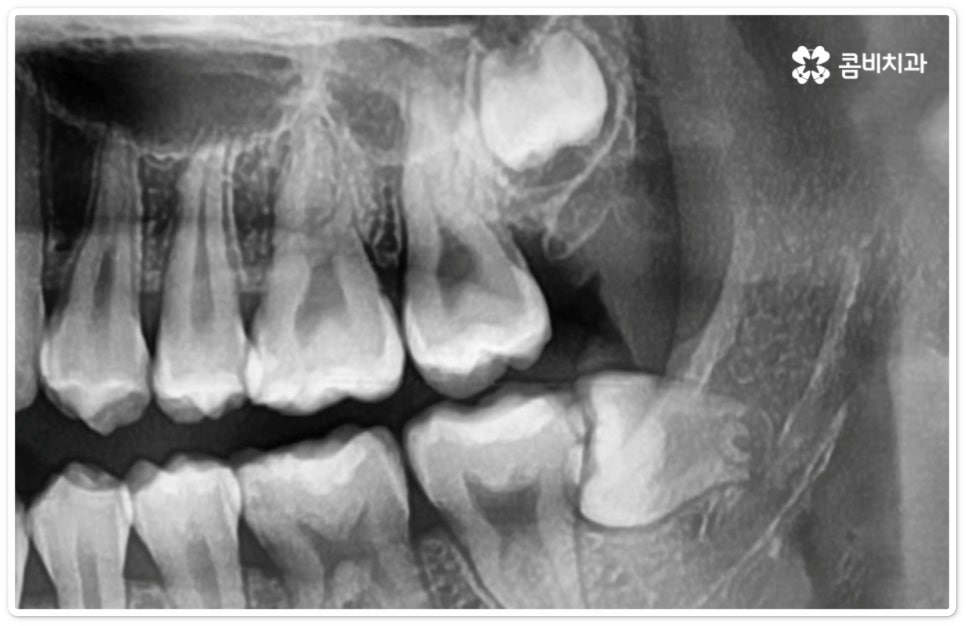 누운사랑니발치 이모저모 알아봐요 관련 이미지 6