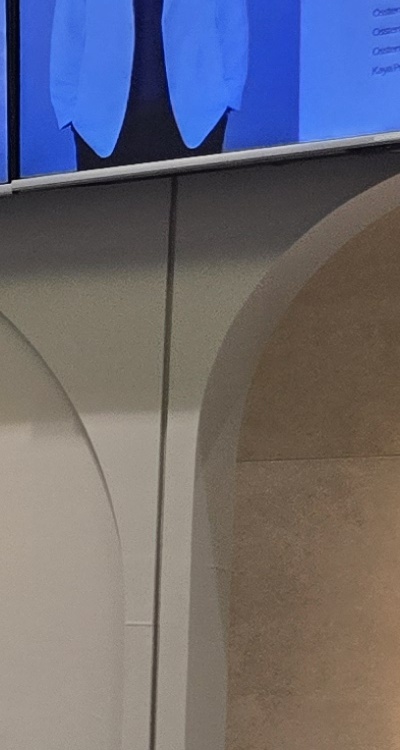 돌출입 팔자주름 교정 얼마나 바뀔까요 관련 이미지 30