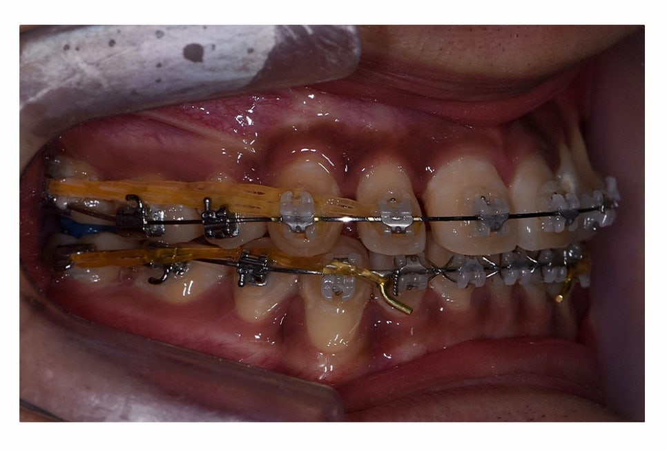 덧니 발치 필수적으로 하는건가요 관련 이미지 16