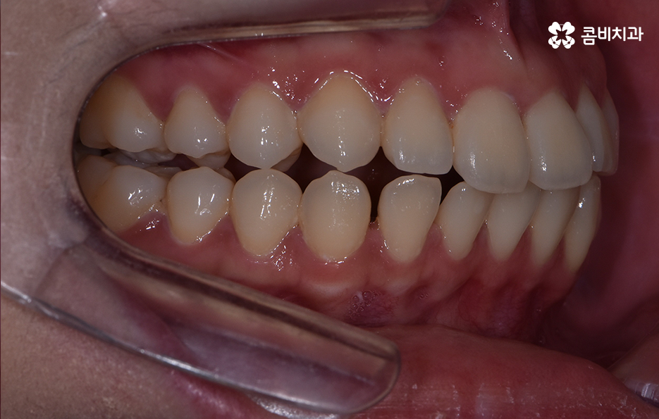 아래앞니 벌어짐 교정으로 해결했어요 관련 이미지 4