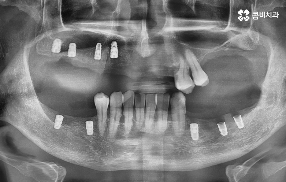 65세이상 임플란트 개수 구체적으로 체크하려면 관련 이미지 8