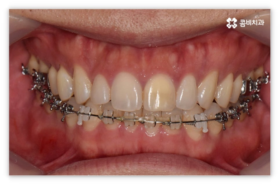 앞니설측교정 망설여질때는 관련 이미지 9