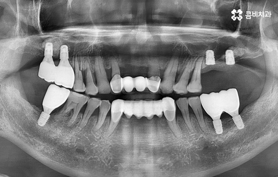 50대임플란트 각별하게 주의해야 하는 시기 관련 이미지 15