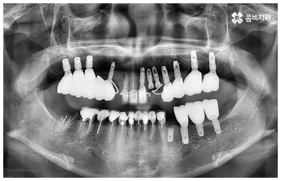 임플란트 치료기간 중점을 두어야 할것은 관련 이미지 9