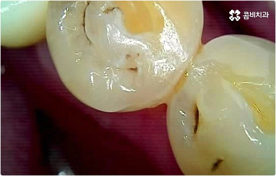 20대임플란트 남의일이 아니라면 관련 이미지 8