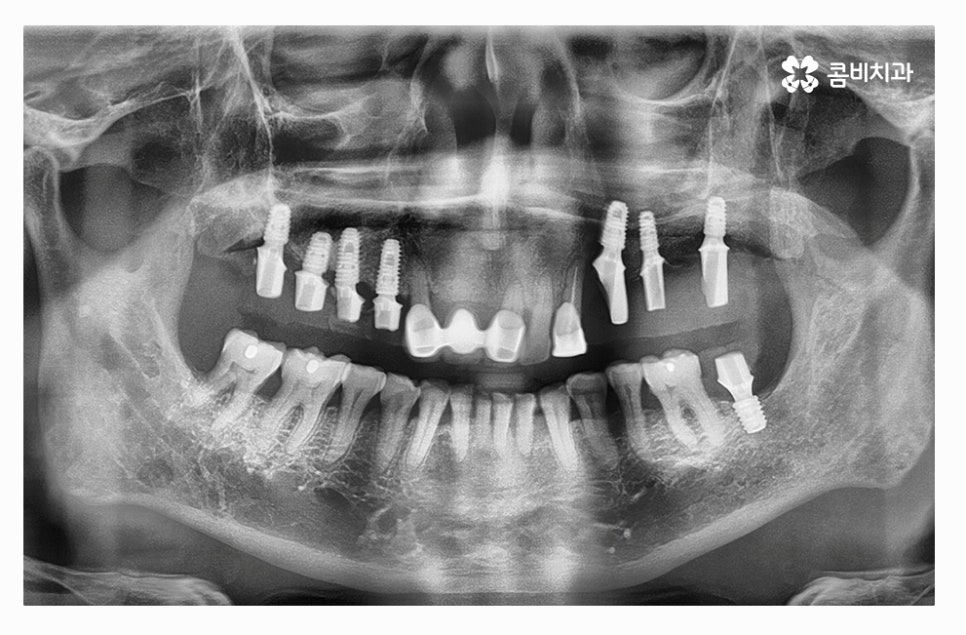 전체임플란트 신중하게 결정하려면 관련 이미지 6