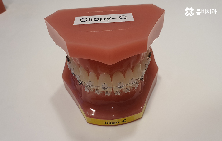 송곳니 덧니 뽑지 않고 해결된 사례 관련 이미지 10