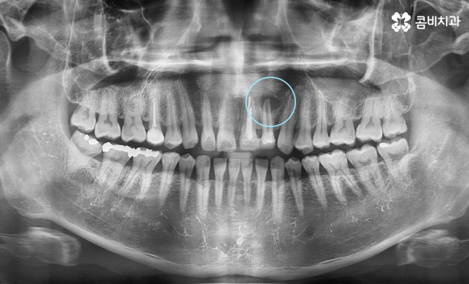 앞니 신경치료 치근단 염증이 발생한 사례 관련 이미지 1