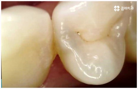 임플란트 종류 어떤게 맞을까요? 관련 이미지 14