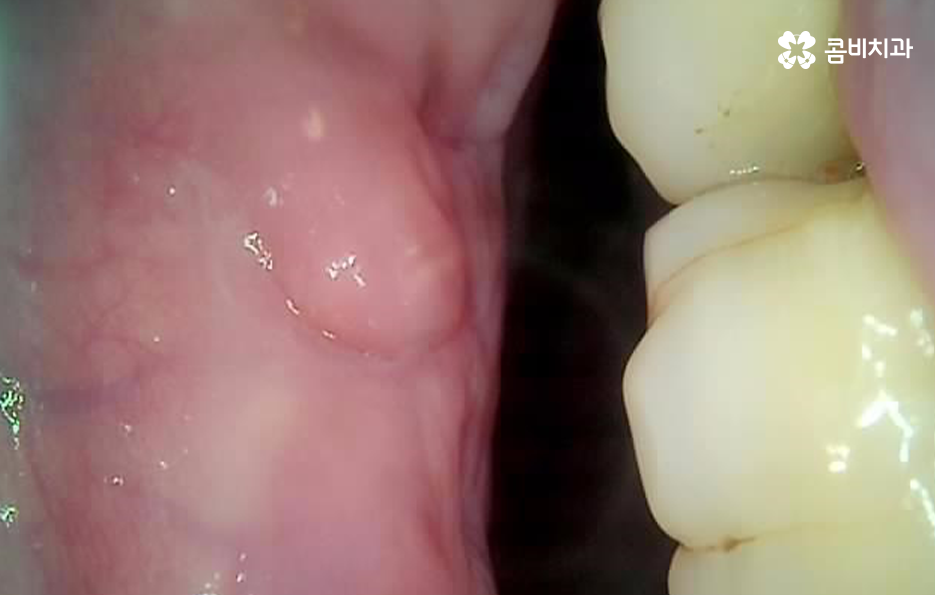 치아 옆면 충치 이렇게 무섭습니다 관련 이미지 8