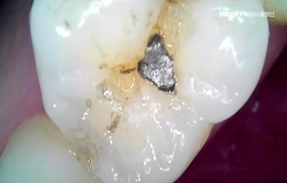 치아 시림 통증 갈수록 심해지다면 관련 이미지 8