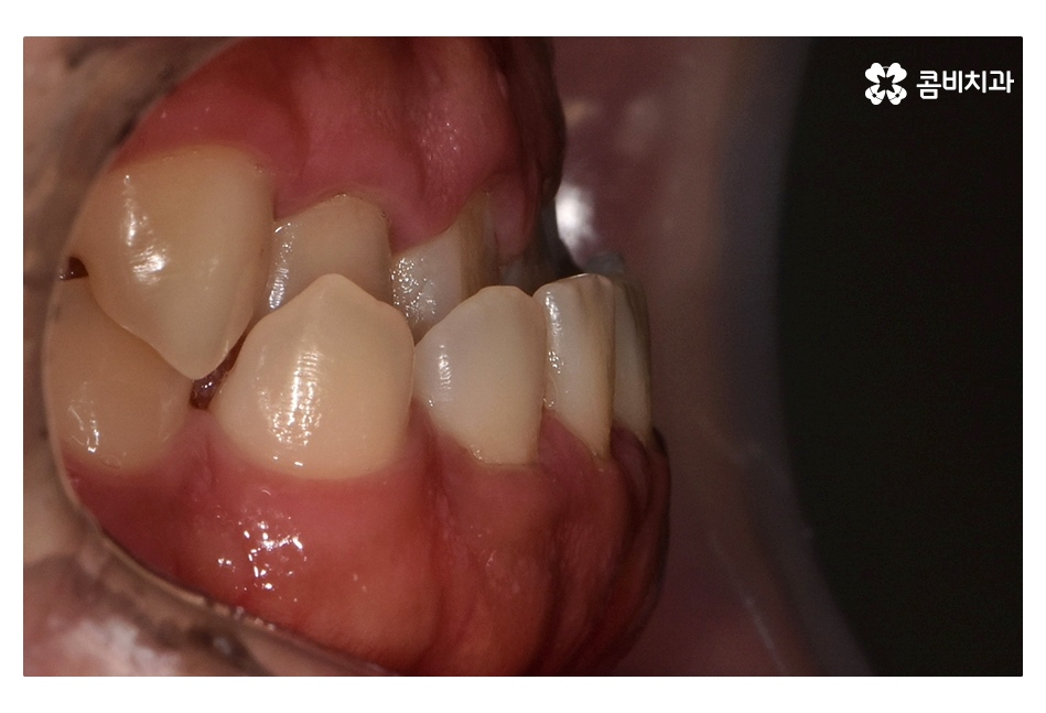클리피씨교정 늦지않게 결정하려면 관련 이미지 3