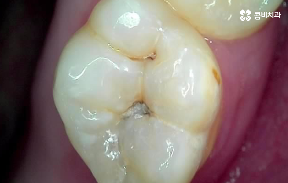 충치 신경치료 안하면 후회하는 이유 관련 이미지 1