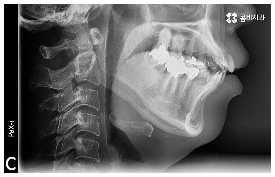 중년치아교정 원한다면 관련 이미지 1