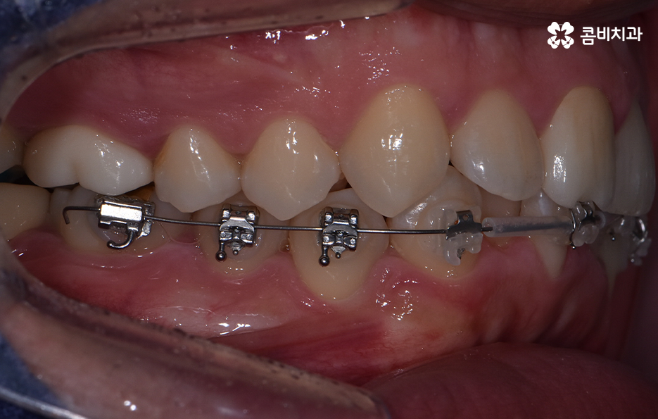 아랫니교정 이렇게만 파악하시면 됩니다 관련 이미지 10