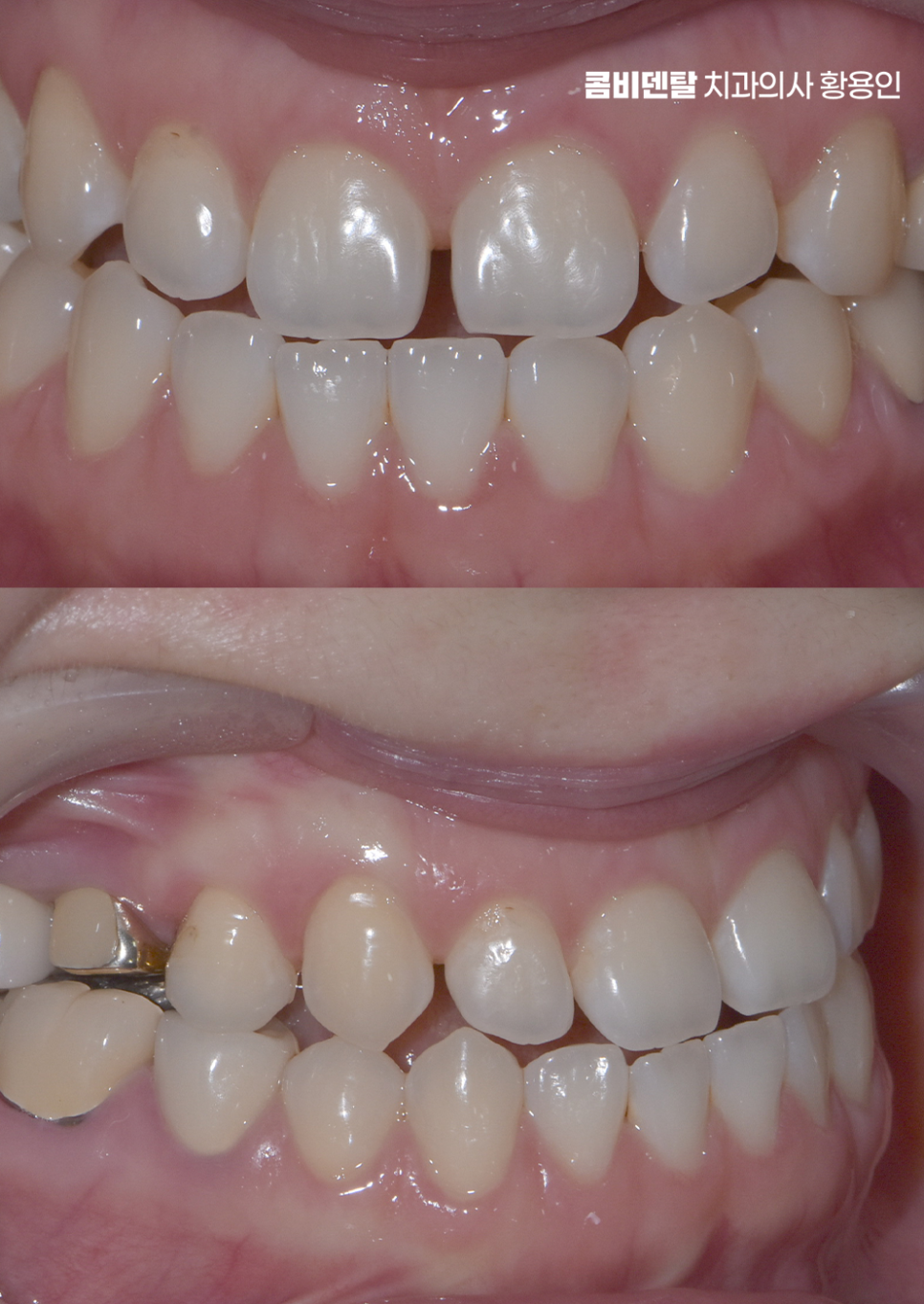 반대교합 치아교정 해결 가능할까 관련 이미지 5