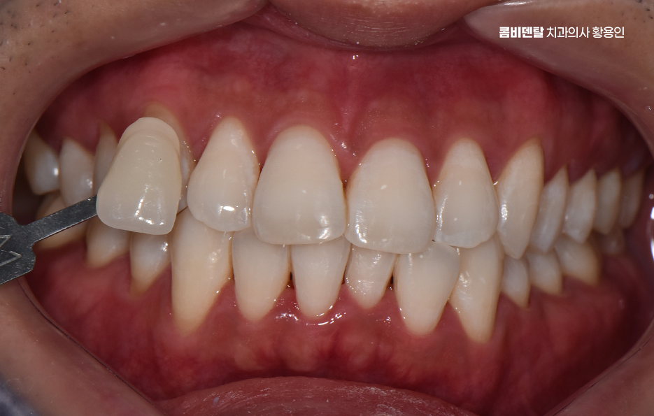 치과 치아미백 효과 어떤식으로 나타날까 관련 이미지 4
