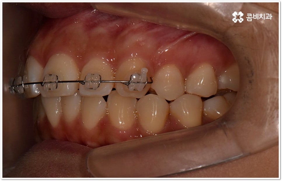덧니부분교정 시작하려면 관련 이미지 11