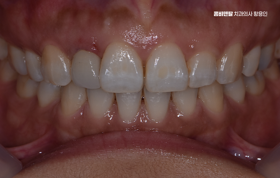 앞니 올세라믹 이건 알고 시작하세요 관련 이미지 8