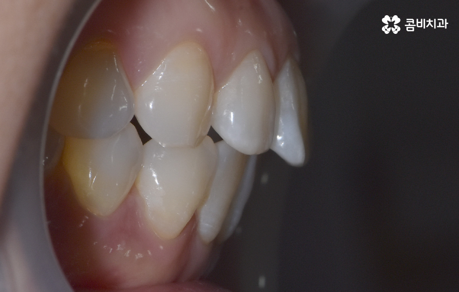 중년치아교정 이제라도 해도 될까요 관련 이미지 4