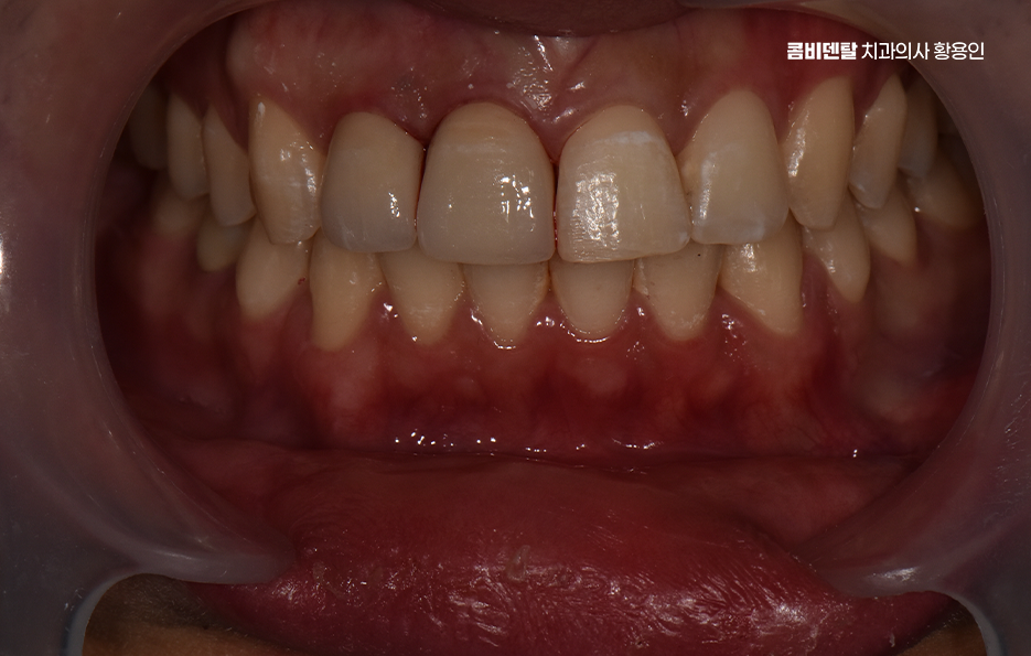 깨진 앞니 크라운 어떻게 해야 깔끔하게 해결될까 관련 이미지 9