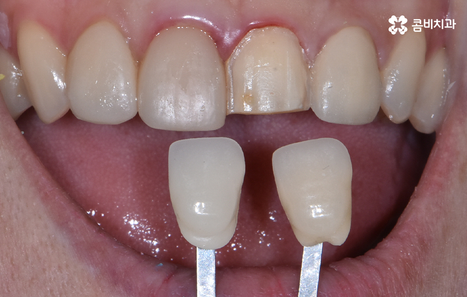 앞니 충치치료 개인에 따라 달라지는 이유 관련 이미지 10
