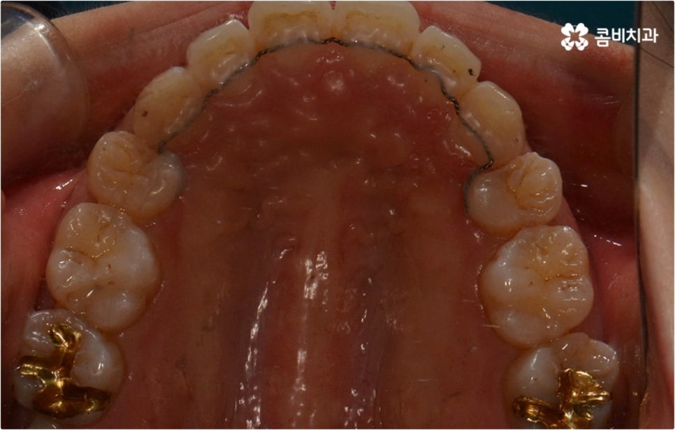 돌출입 치아교정 부모와 아이가 함께 알아봐요 관련 이미지 15