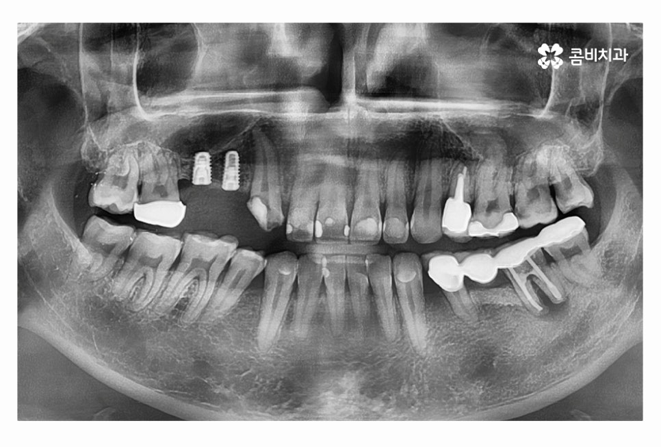 20대임플란트 갈수록 늘어나는 이유는 관련 이미지 8