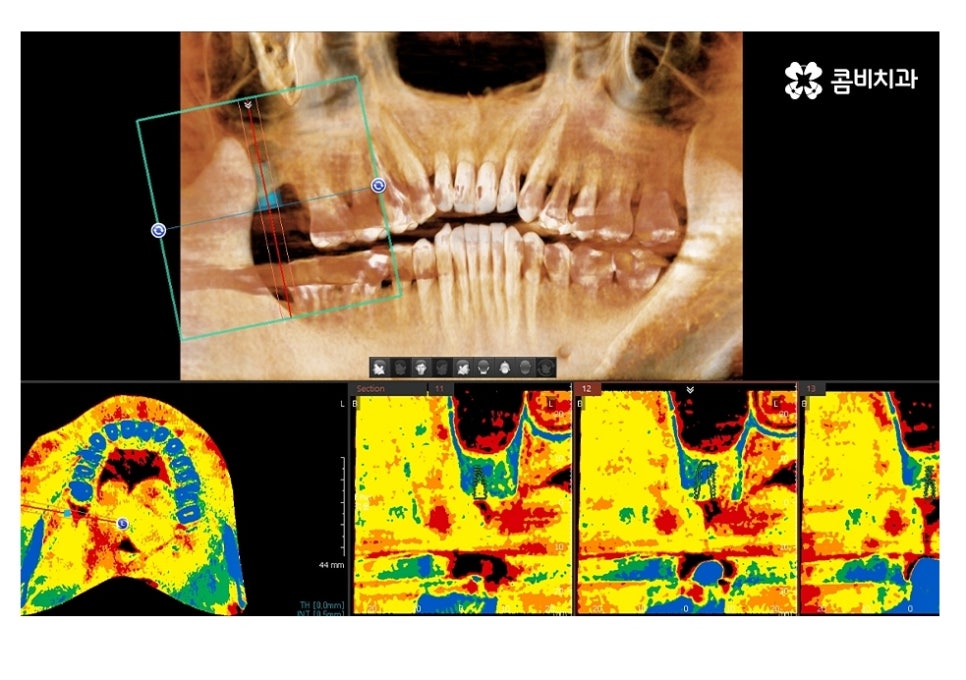 20대임플란트 잦아지는 이유를 알아본다면 관련 이미지 1