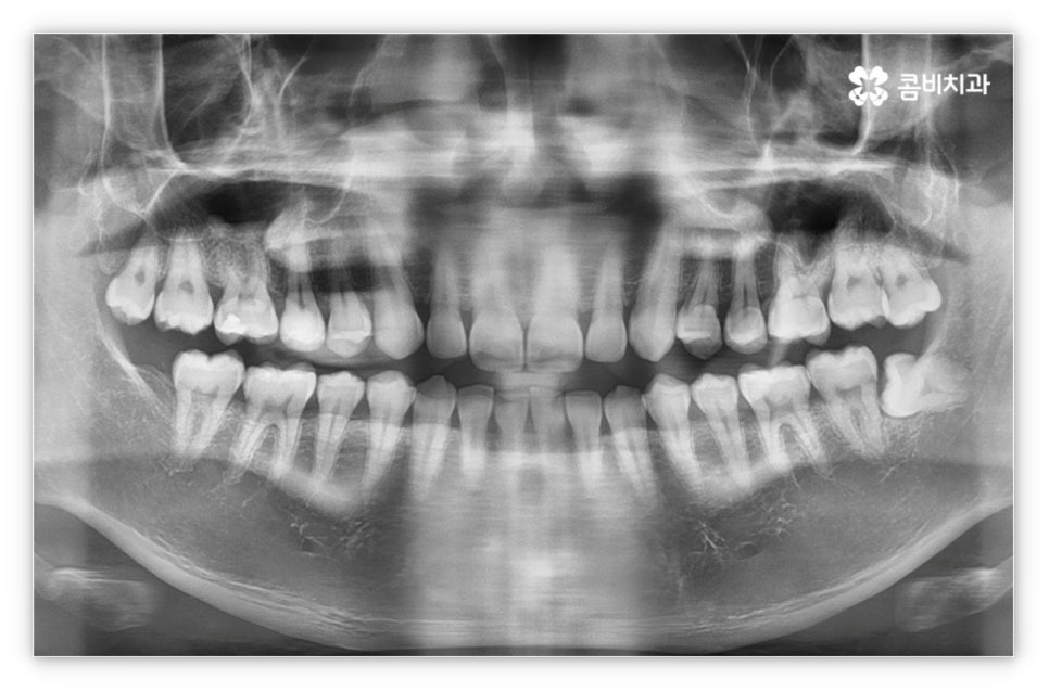 앞니설측교정 망설여질때는 관련 이미지 1