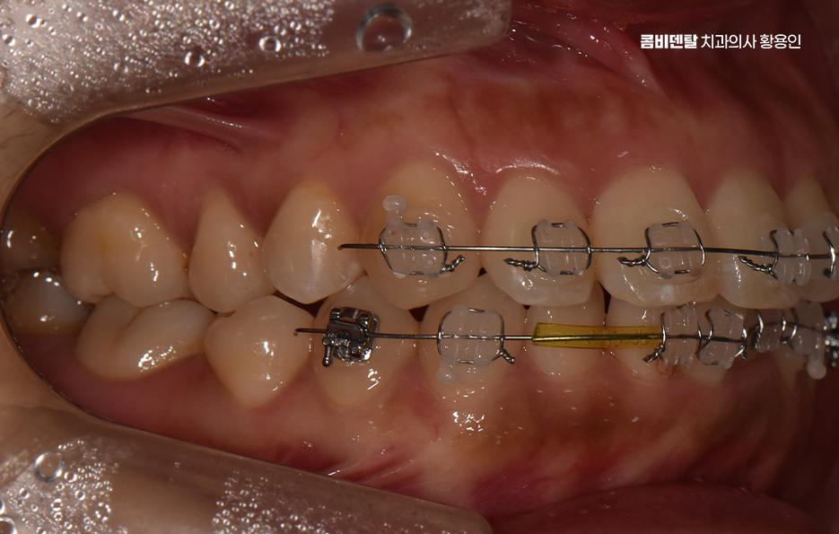앞니 부분 교정 간단하니까 좋은건가요 관련 이미지 8