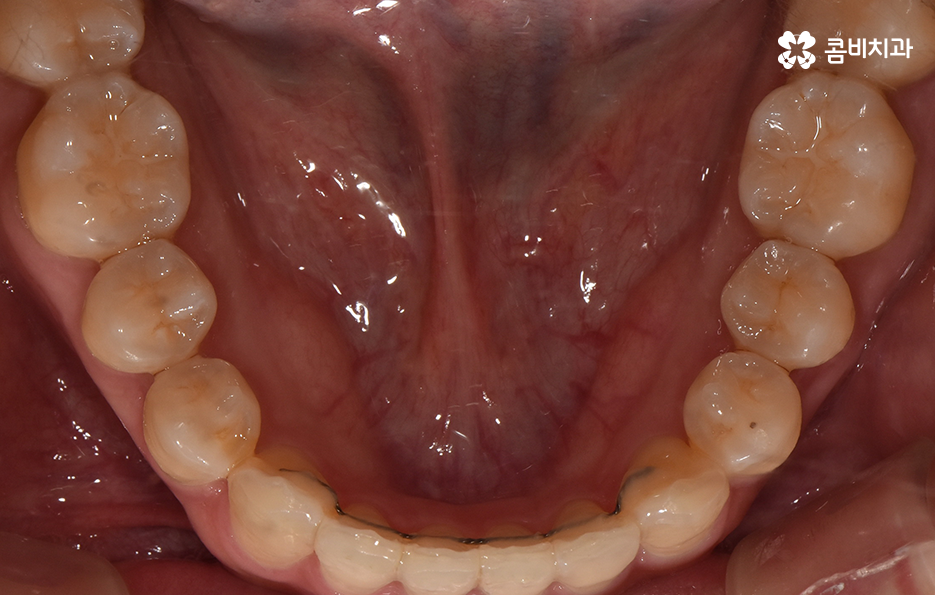비발치치아교정 고민되는데 발치하면 안좋나요 관련 이미지 14