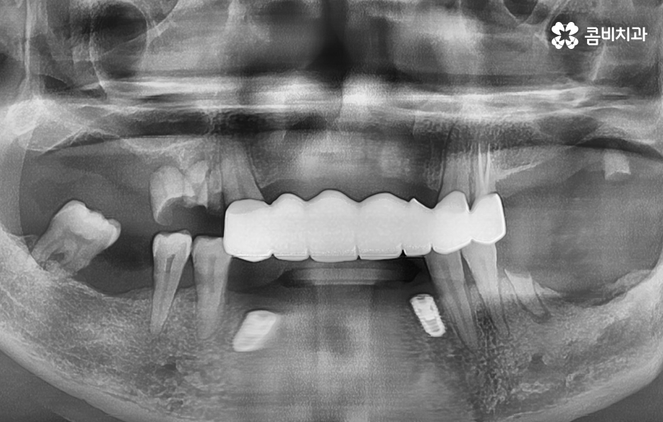 치주염 발치 이렇게나 심각하네요 관련 이미지 10
