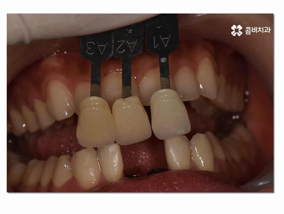 치주염으로 인한 아랫니 임플란트 절차를 알아보면 관련 이미지 10