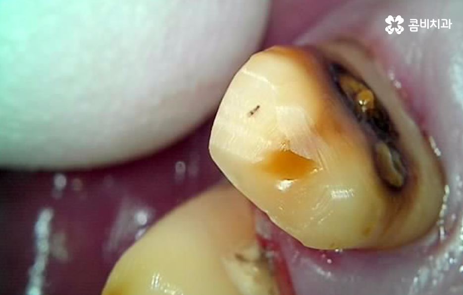 치주염 발치 이렇게나 심각하네요 관련 이미지 4