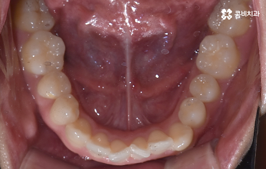 덧니 발치교정으로 교정할 때 치아가 이렇게 이동해요 관련 이미지 6