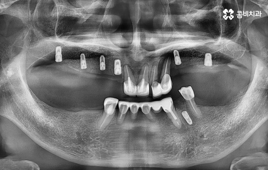임플란트 나이 얼마나 영향을 줄까 관련 이미지 4