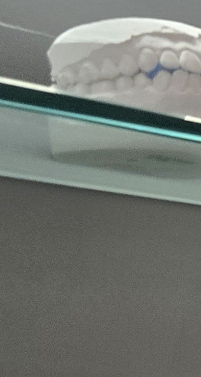 완전매복사랑니 발치 대학병원 꼭 가야하나요 관련 이미지 21