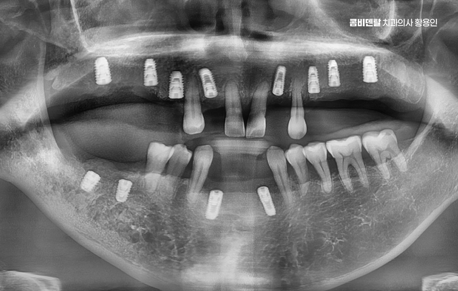 50대임플란트 꼼꼼하게 따져봐야할 포인트는 관련 이미지 6