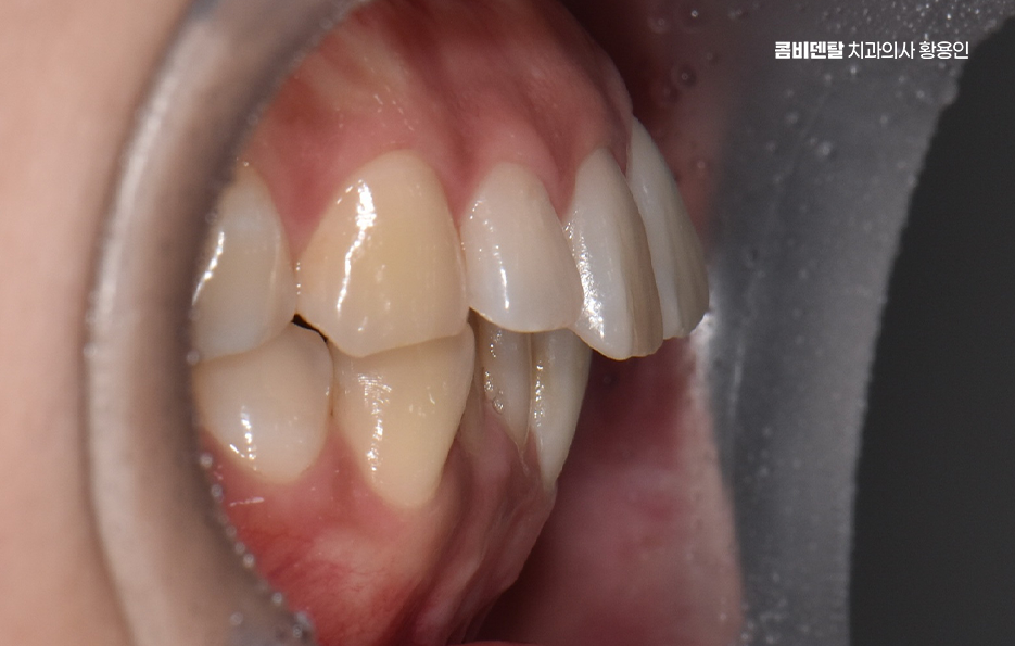 앞니 틀어짐 교정 이렇게 파악하세요 관련 이미지 3