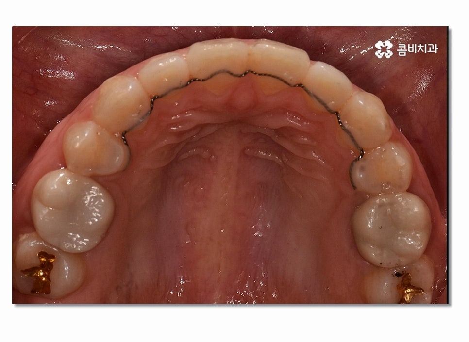 돌출입치아교정 부담이 크게 느껴진다면 관련 이미지 14
